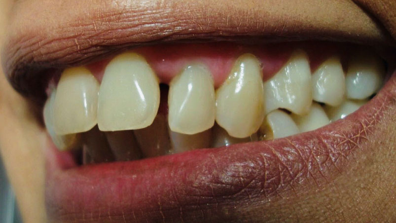 Diastemas: dientes separados - Antes