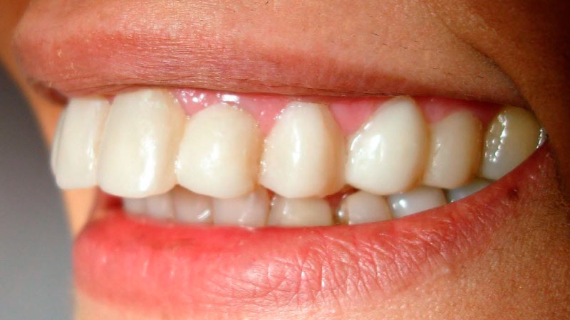 Diastemas: dientes separados - Después