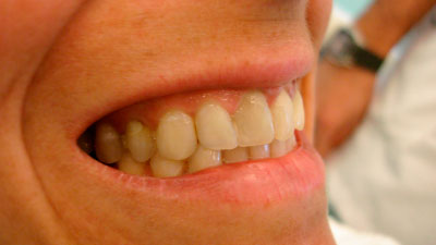 Feminizar sonrisa - Antes